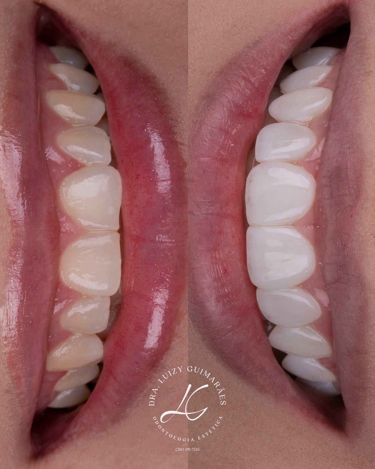 Antes e depois de facetas de resina — detalhe em macro