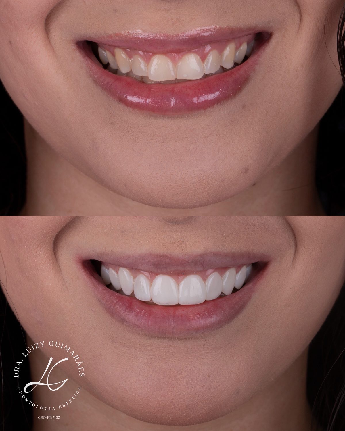 Antes e depois de facetas de resina — sorriso frontal
